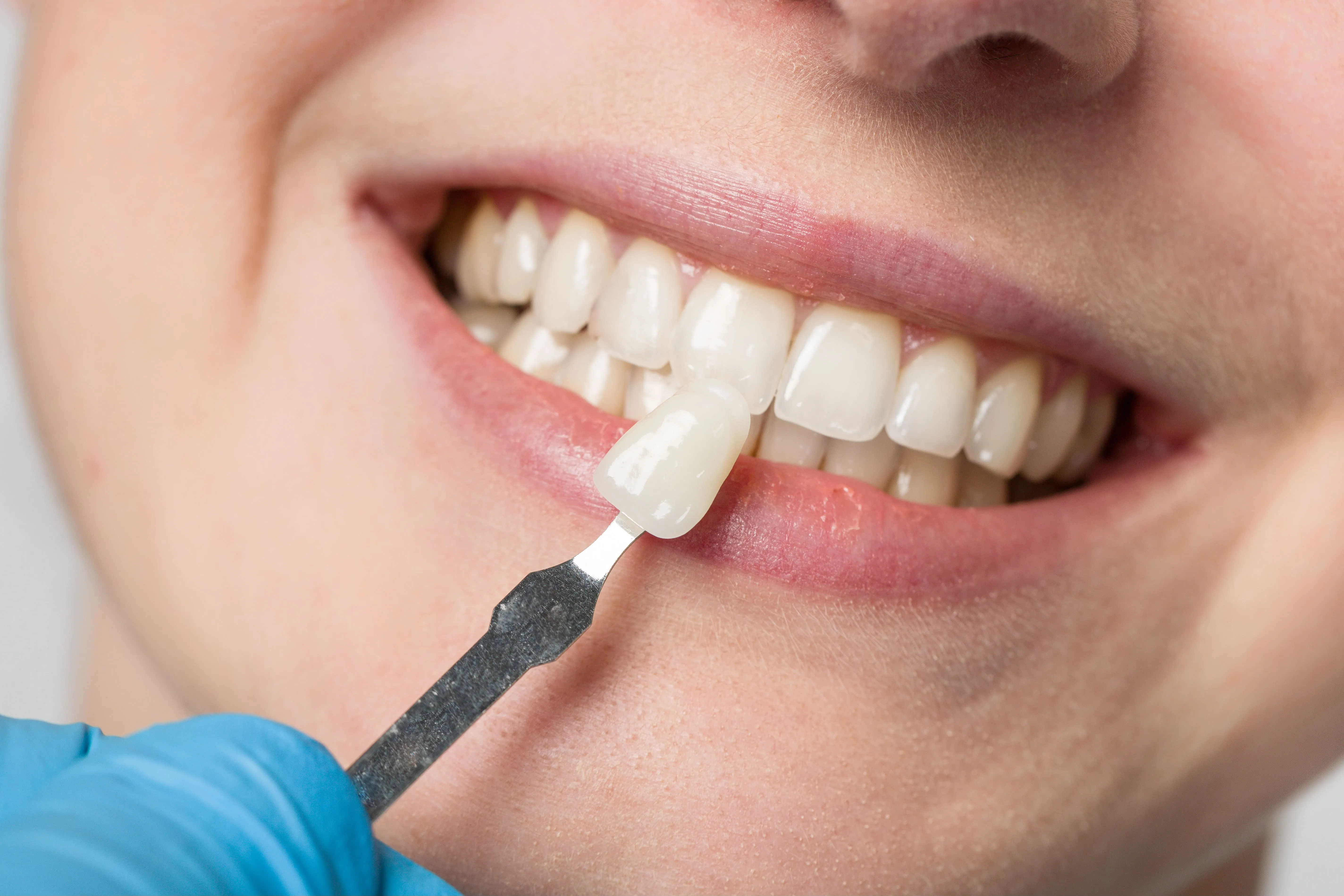 A patient with a shade guide held up to their teeth