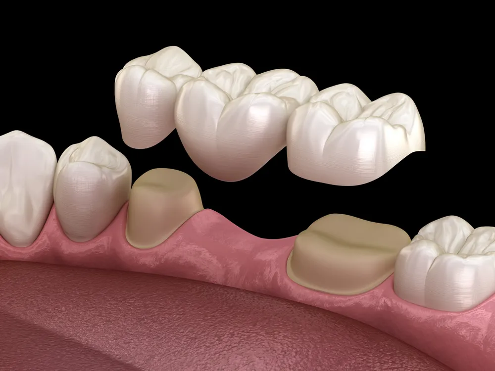 A three-unit dental bridge above two prepared teeth