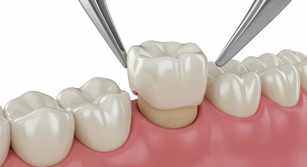 A dental crown being lowered onto a prepared tooth