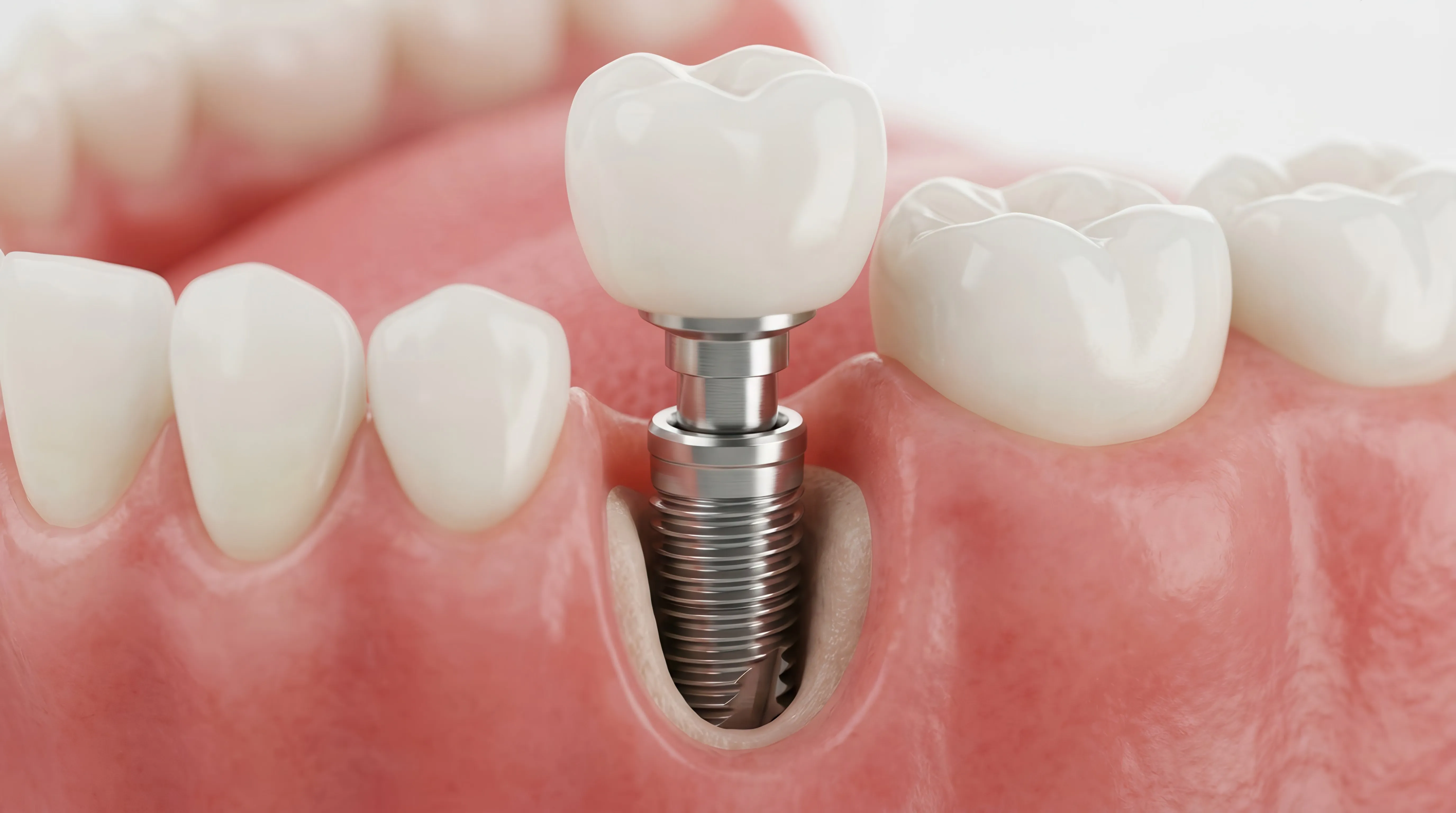 A dental implant