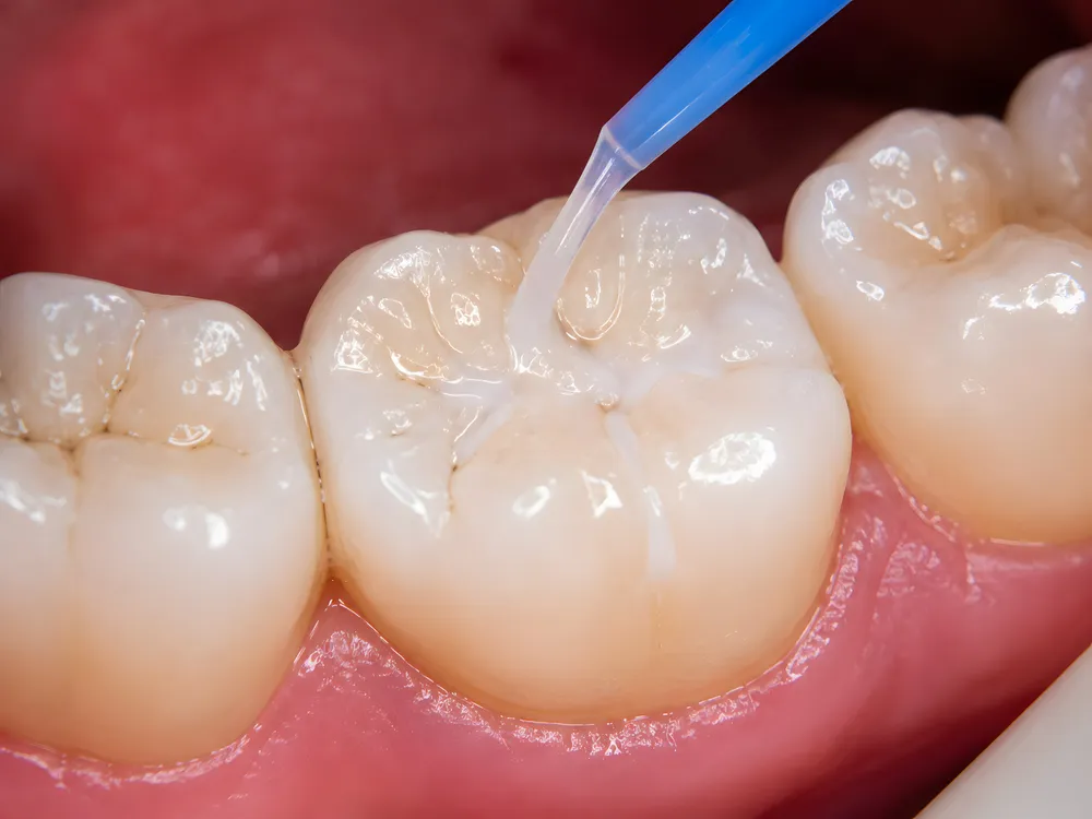 Dental sealant being applied to a molar