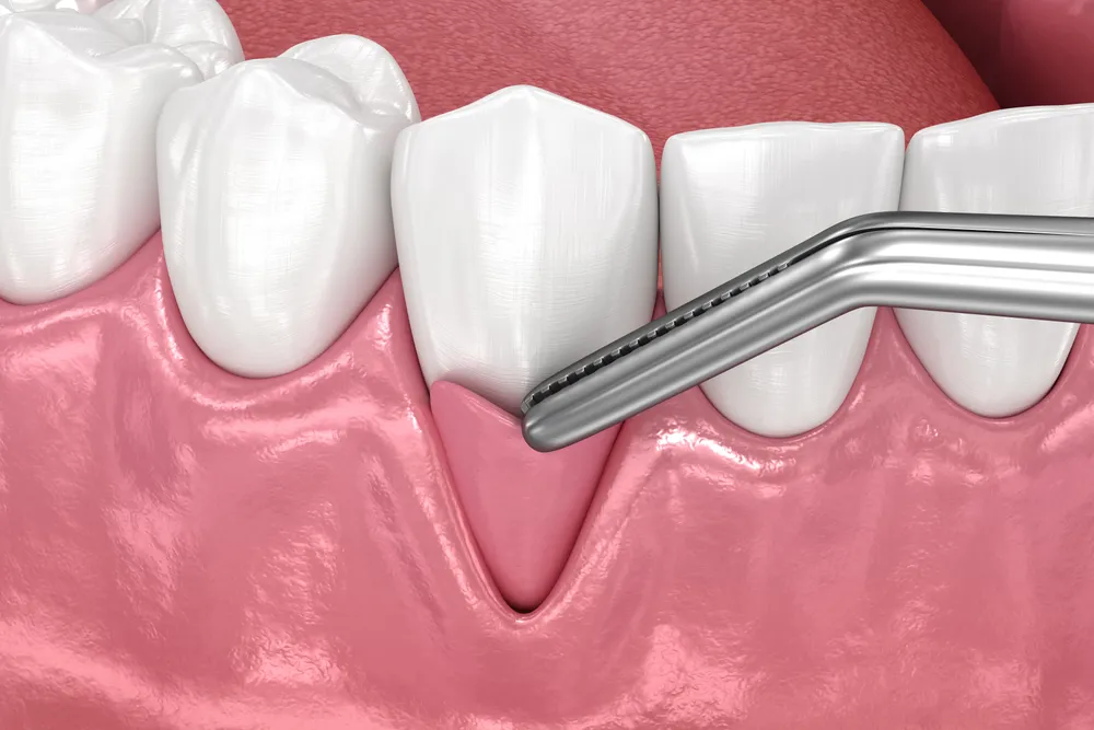 A gum graft being placed on a patient’s gums