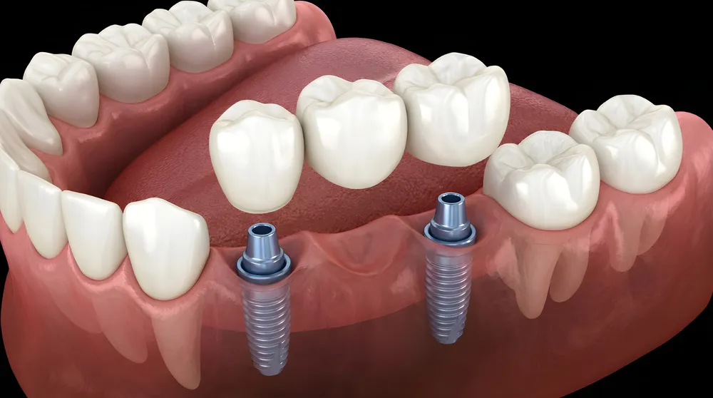 An implant-supported bridge