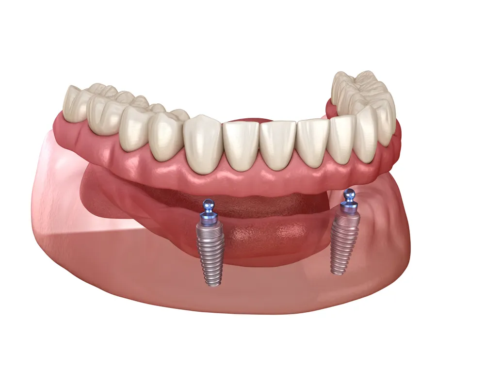 An implant overdenture or snap-on denture