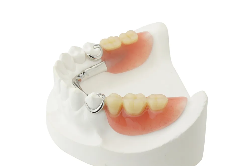 A partial denture with metal clasp