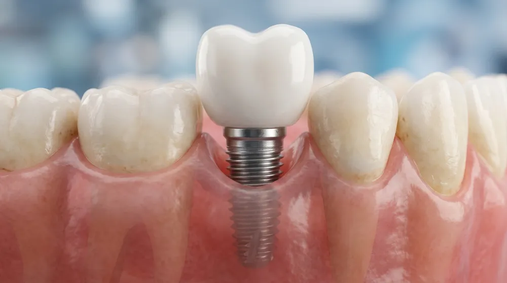 A single dental implant