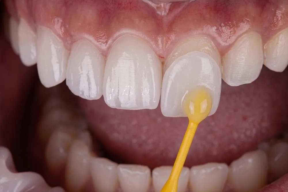 A veneer being bonded to a front tooth