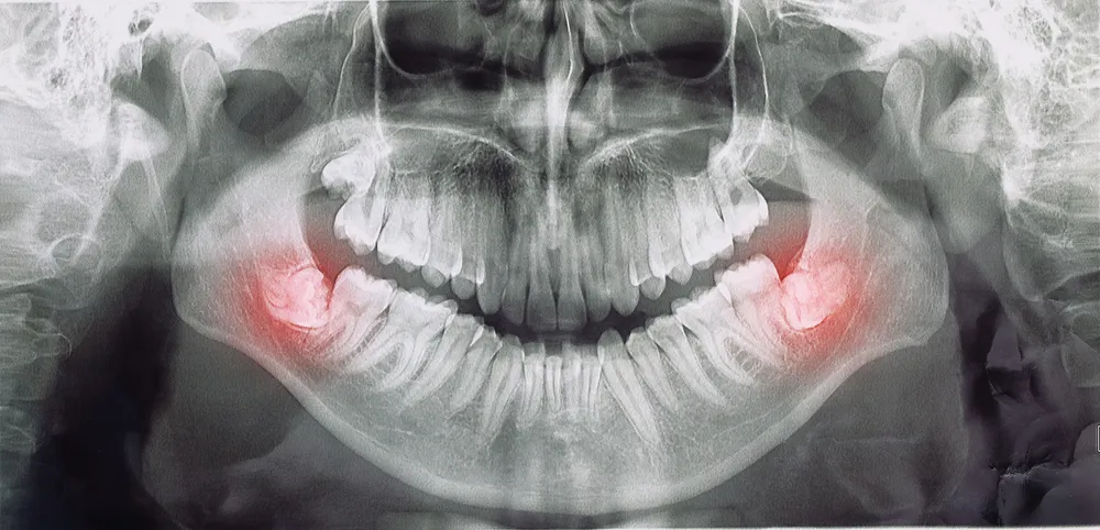 A panoramic X-ray with two impacted wisdom teeth highlighted